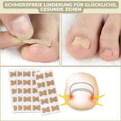 CURVENA - Ingrown Nail Correction Strips for Gentle Pressure Relief