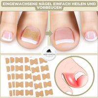 CURVENA - Ingrown Nail Correction Strips for Gentle Pressure Relief