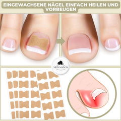 CURVENA - Ingrown Nail Correction Strips for Gentle Pressure Relief