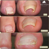 CURVENA - Ingrown Nail Correction Strips for Gentle Pressure Relief
