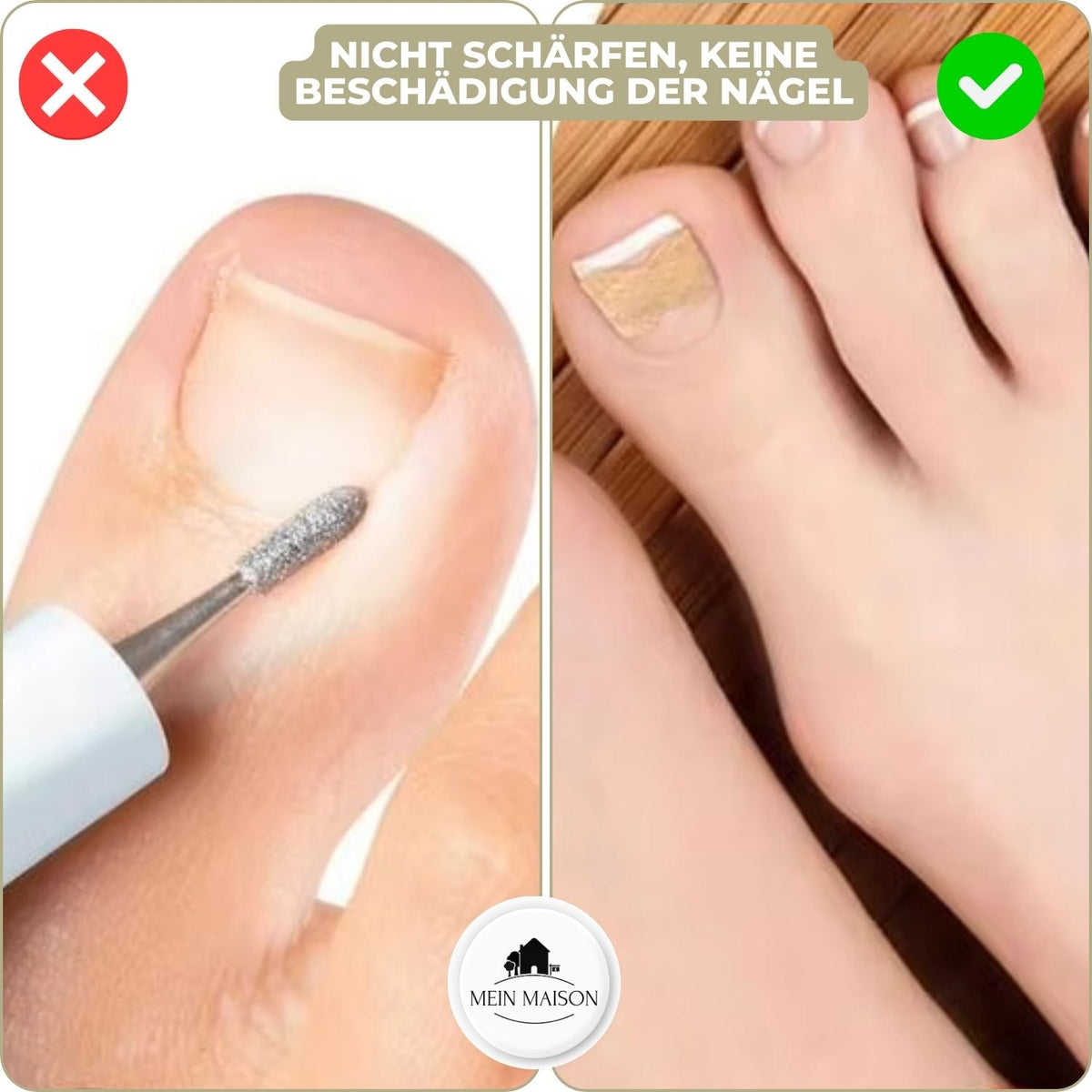 CURVENA - Ingrown Nail Correction Strips for Gentle Pressure Relief