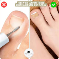 CURVENA - Ingrown Nail Correction Strips for Gentle Pressure Relief