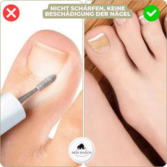 CURVENA - Ingrown Nail Correction Strips for Gentle Pressure Relief